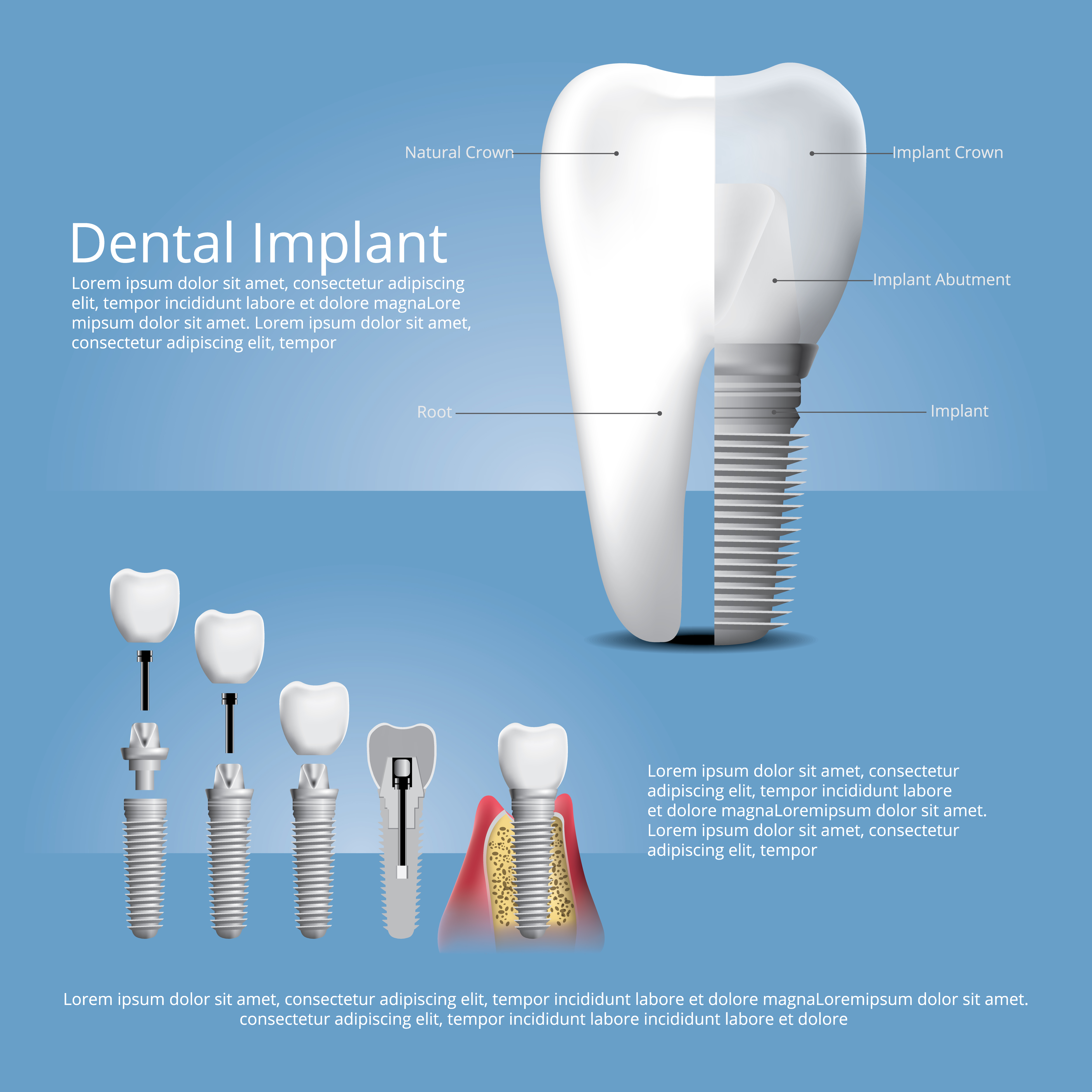 Dental Implant In Pune